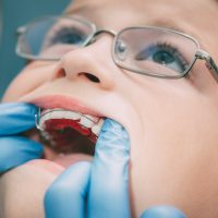 Dentist checking mobile orthodontic appliance for dental correction to the child patient. Close-up. Real People.